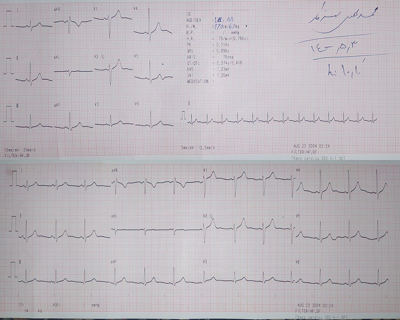 Electrocardiograma de 12 derivaciones impreso en papel milimetrado